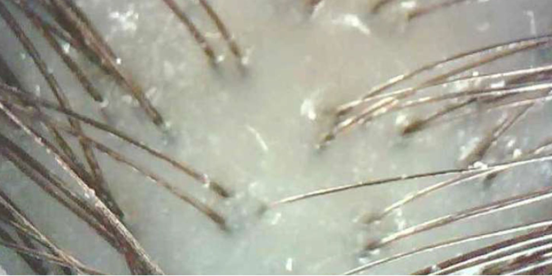 Vue microscopique du cuir chevelu avant l'application du sérum à la soie.
